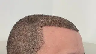 Trapianto di Capelli: Quali Medicinali Assumere Dopo l'Intervento? 💊 Guida Completa