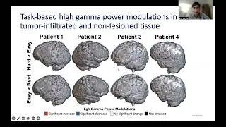 On the origins of glioma: insights from brain network mapping
