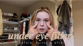 I GOT UNDER EYE FILLER | before, during & after | @lindsrosso