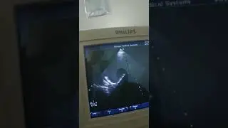 2D echo 14/M
