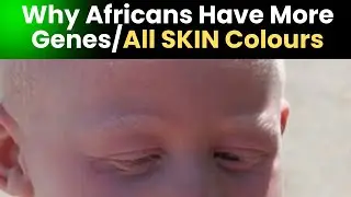 African Albinism & Human Evolution #live #life #biology #health #food #africa
