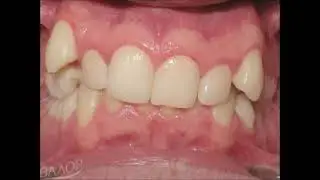 🔥 CANTING of occlusal plane. BRACES TIMELAPSE - before and after / amazing, deep bite correction.