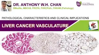 Liver Cancer Vasculature - Pathological Characteristics and Clinical Implications