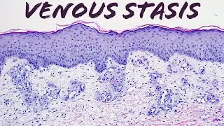 Venous stasis vascular change (pathology dermatology dermatopathology)