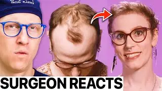Patient's Life Changing Hair Transplant After Her Transition | Surgeon Reacts