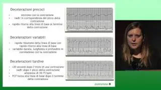 La lettura del tracciato cardiotocografico: uptodate sulle linee guida - A. Sorz