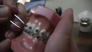 How to handle emergencies with braces at home - Faces Orthodontics
