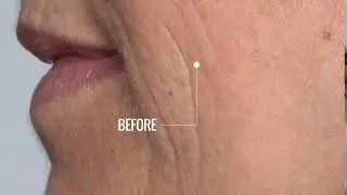FIXMD Clinical Results: Before & After Activate Eye Cream