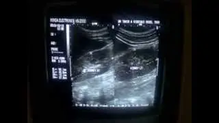 CONJOINED  KIDNEYS
