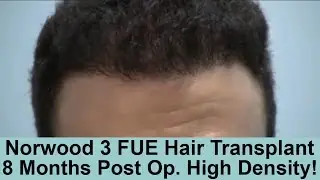 Caucasian Male 8 Months Post Op. 2000 Graft FUE Hair Transplant - Norwood 3 pattern