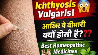 Ichthyosis vulgaris ( extremely dry skin ) treatment !! Symptoms,causes & best homeopathic medicines