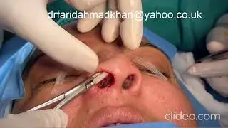 #nosejob#scarlesssurgery#nasalimplant
