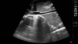 Case 15: The Collapsed inferior vena cava (IVC) - 1