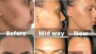 My Skin Care Journey.