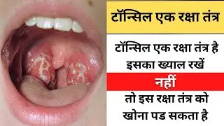 Testimony of atomy propolis toothpaste on swollen and infected tonsils