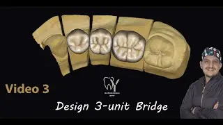 how to design 3 unit bridge on exocad? كيفية تصميم كوبري علي برنامج الexocad