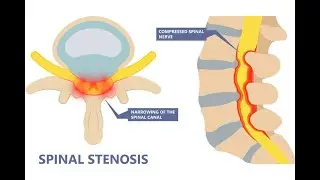 Lumbar Spinal Stenosis and the MILD Procedure