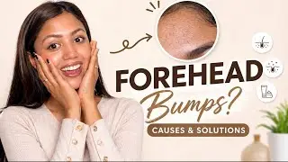 Why your forehead has Tiny Bumps l Nepali Complete Guide for clear skin 🌸