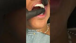 Affordable way to correct an underbite 🥰