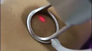 Fraxel CO2 (laser) лазер