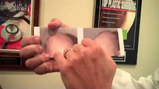FUE Hair Transplant - 2000 Grafts
