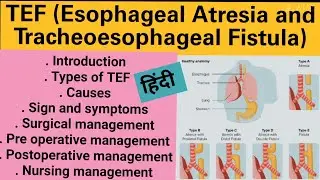 TEF (Tracheoesophageal fistula) Esophageal Atresia/Pediatrics/Child Health Nursing/In hindi/Nursing