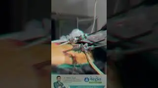 Laparoscopic Inguinal hernia,  #hernia #herniasurgery #laparoscopicherniasurgery #Bestherniahospital