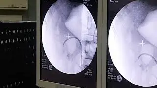 Film of image intensifier showing flexible endoscope