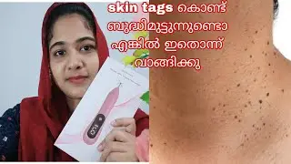 Beauty mole and warts removal sweep spot pen review| how to remove warts and skin tags|