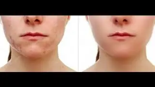 TUTO PHOTOSHOP : COMMENT LISSER LA PEAU (séparation des fréquences)