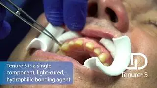 Tenure&reg; S -30-Second Dentistry&trade;  - Patient: Randy
