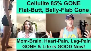 Amazing Cellulite Success Story Plus Major Health Improvements Beyond Cellulite from Stephanie G