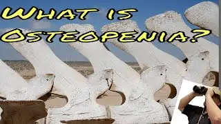 What is Osteopenia?  A brief description of what osteopenia and osteoporosis are.