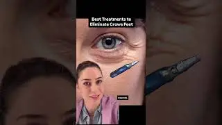 Best Treatments for Crows Feet! #wrinkles #antiaging
