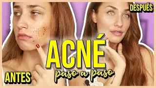 CÓMO CUBRIR ACNÉ CON MAQUILLAJE PASO A PASO | Roaccutan | Juli Berea