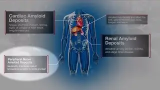 The Trouble with Diagnosing a Rare Disease