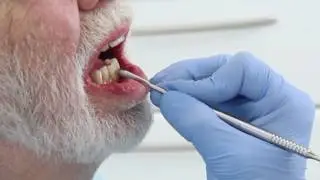 Superb retention and stability of complete lower denture without implants.
