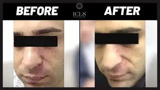 How to Remove Port Wine Stain | Birthmark Removal Treatment | ICLS Dermatology & Plastic Surgery