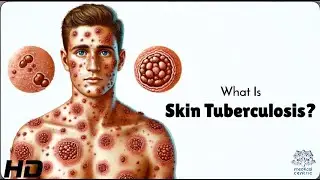 Skin TB Unveiled: Is Your Skin at Risk?