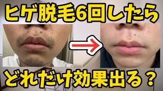 【ヒゲ医療脱毛】6回したらどれだけ効果出る？？【1週間写真撮って比較してみた】