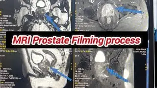 MRI prostate scaning Filming process by Egy methods/ How to do MRI prostate filming Process