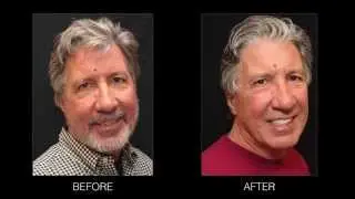 Composite Bonding & Adult Orthodontics: Tom