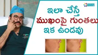 Acne Treatment | Pores | Skin | Pimples | Scars | Spots |  Removal | Cheeks | Softening | Sriroop