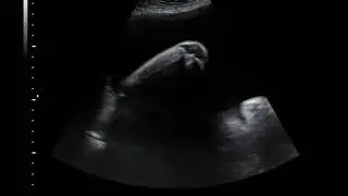 Congenital Talipes Equinovarus