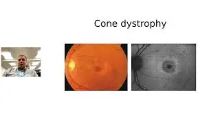 An overview of cone dystrophies with Thales A.C. de Guimarães