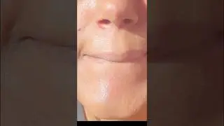 Sebogel for Blackheads Whiteheads Removal || Pharmacy Skincare #shorts