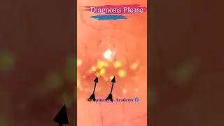 Drusen | Hard exudates | Macular Pathology |  macular scar | Short Video 83 #viralvideo