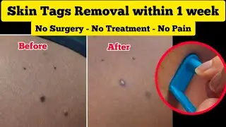How to Remove Skin Tags Without Pain - No Surgery, No Treatment / Skin Tag Removal Kit Review