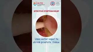 Say goodbye to the struggles of BPH with Rezūm Water Vapor Therapy!