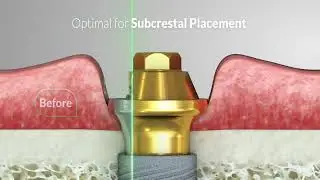 Classic vs. Innovative Alpha&trade; Arch Design